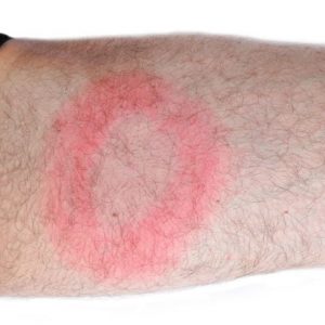 Malattia di Lyme: 10 segni da tenere d’occhio Malattia di Lyme: 10 segni da tenere d’occhio