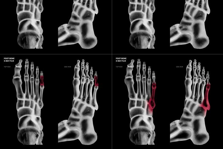 Cose da sapere sulle dita dei piedi rotte 9