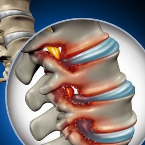 10 sintomi della stenosi spinale