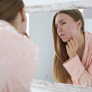 Quali sono le cause dell’acne?