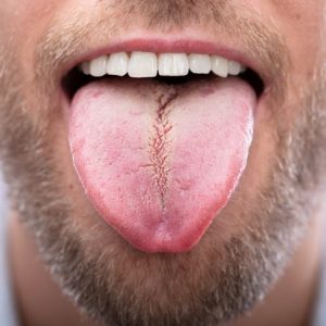 Cause, effetti e segni di una lingua increspata Cause, effetti e segni di una lingua increspata