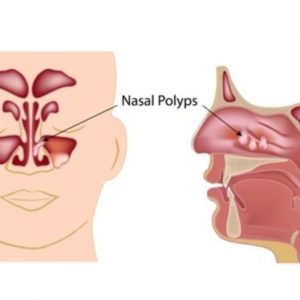 Rimedi tradizionali e domestici per i polipi nasali
