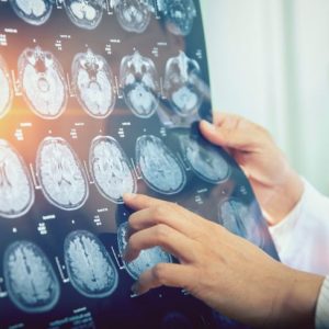 Sindrome di Dandy-Walker: Una malformazione cerebrale congenita Sindrome di Dandy-Walker: Una malformazione cerebrale congenita