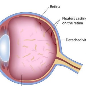 Cause, sintomi e trattamenti dei floaters oculari