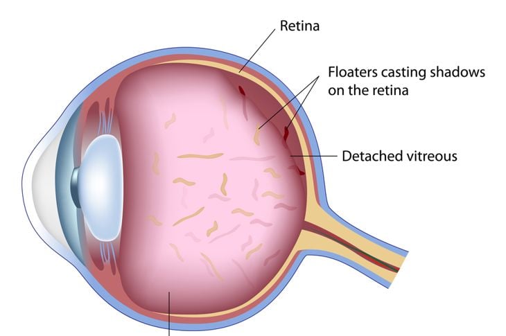Cause, sintomi e trattamenti dei floaters oculari 1