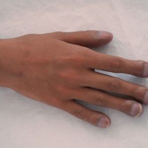 Le dita bastonate come segno precoce di malattia