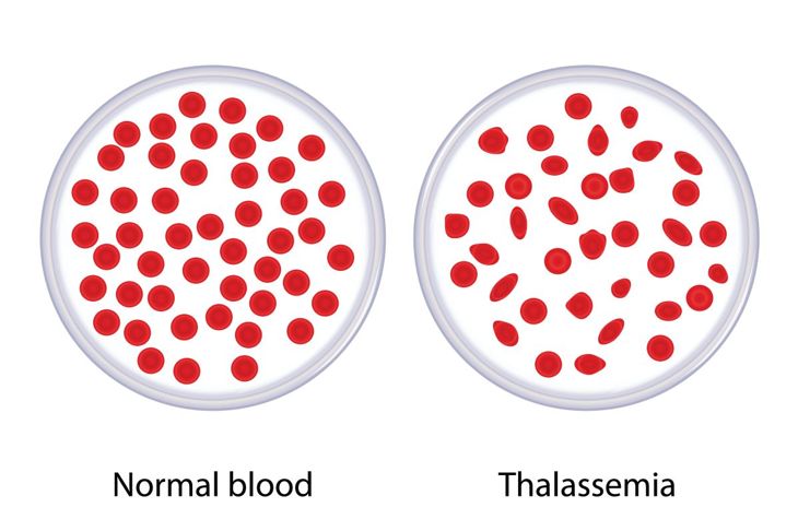 Tipi di anemia microcitica 7