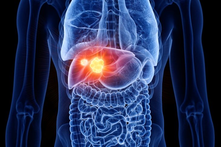 10 trattamenti per il cancro del colon-retto 13