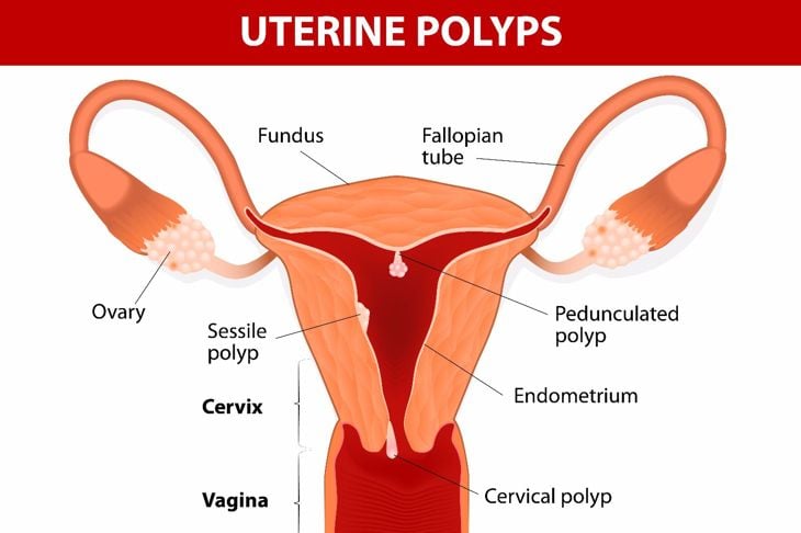 8 Cause e trattamenti del sanguinamento uterino anomalo 7