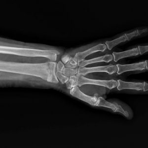 Diagnosi e trattamento di una frattura di Colles Diagnosi e trattamento di una frattura di Colles