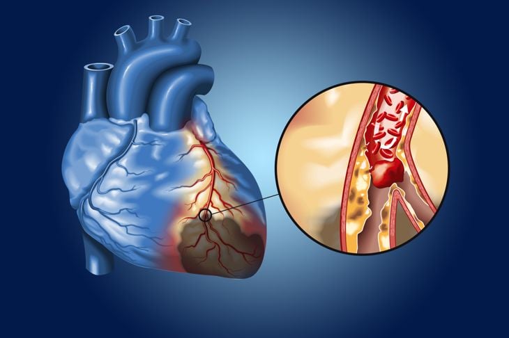 Ischemia cerebrale, cardiaca e intestinale 9