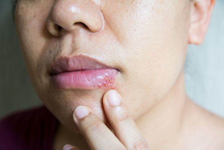 9 segni di herpes che non si possono ignorare 17