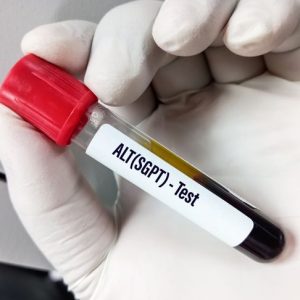 Capire gli esami del sangue ALT e i loro risultati