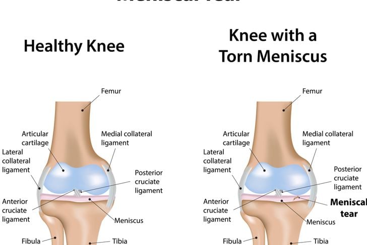 Le 10 cause più comuni di dolore al ginocchio 9