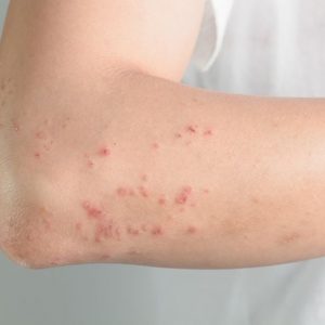 Quanto è contagioso l’herpes zoster? Quanto è contagioso l’herpes zoster?