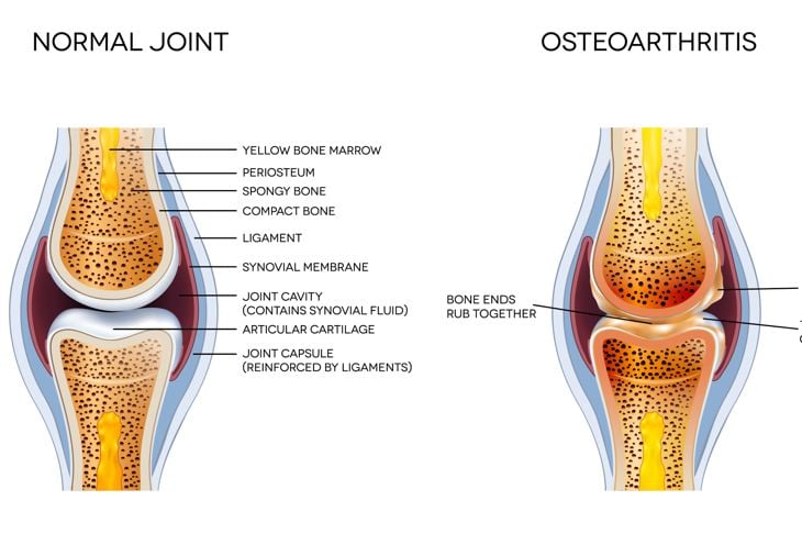 Le 10 cause più comuni di dolore al ginocchio 19
