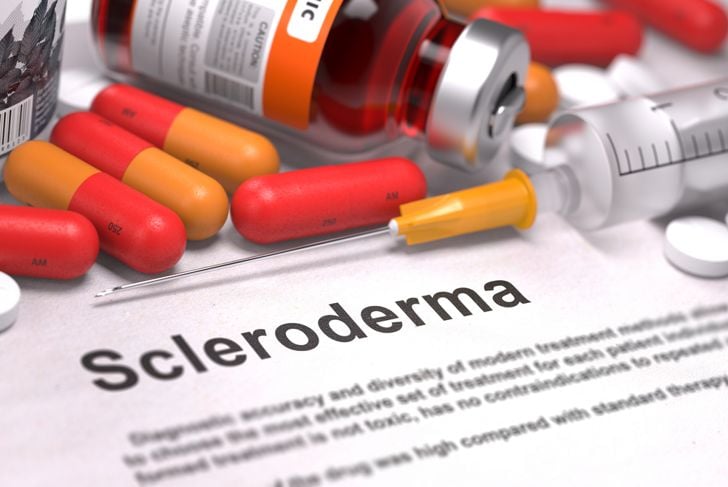 10 sintomi della sclerodermia 15