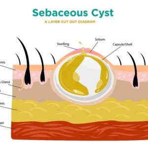 10 Sintomi e trattamenti delle cisti sebacee 10 Sintomi e trattamenti delle cisti sebacee