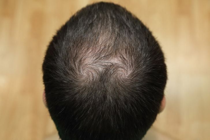 Le 9 principali cause di perdita di capelli negli uomini 11