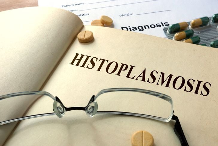 10 Sintomi e trattamenti dell'istoplasmosi 15