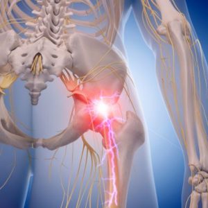 I glutei sono doloranti? Potrebbe trattarsi della sindrome del piriforme