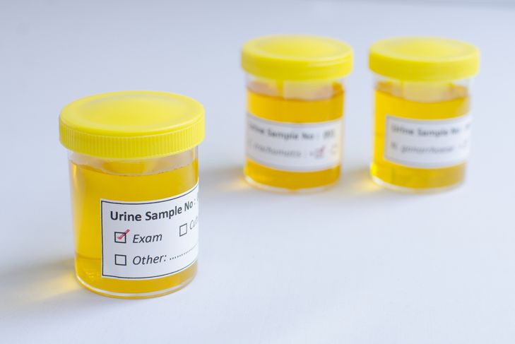 9 sintomi di infezione delle vie urinarie 7