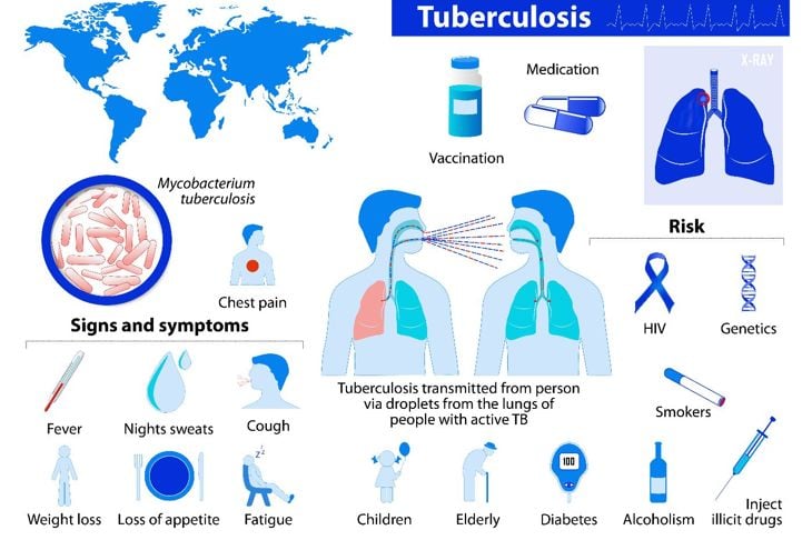 Che cos'è la tubercolosi polmonare? 19