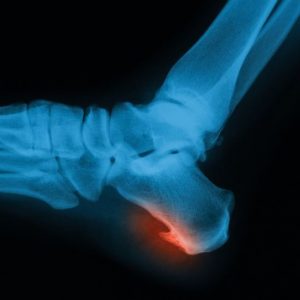 Diagnosi, cause e trattamento dell’esostosi Diagnosi, cause e trattamento dell’esostosi