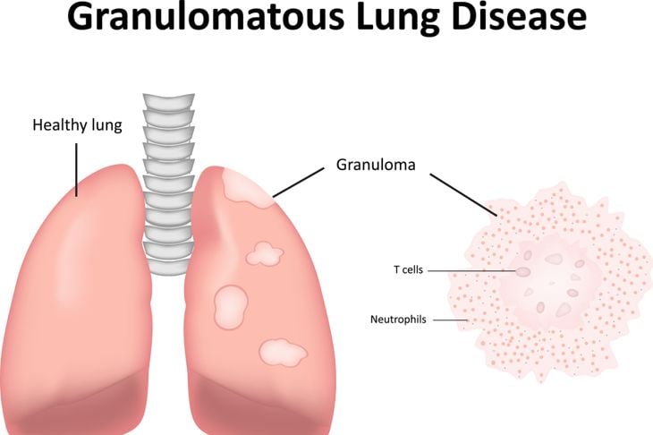 Sintomi e cause della granulomatosi con poliangioite 9