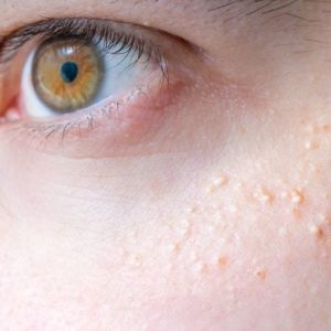 10 sintomi del carcinoma basocellulare 10 sintomi del carcinoma basocellulare
