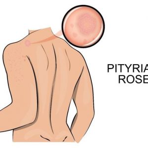 Pityriasis Rosea: 10 sintomi e trattamenti