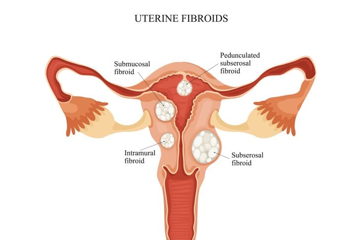 8 Cause e trattamenti del sanguinamento uterino anomalo 5
