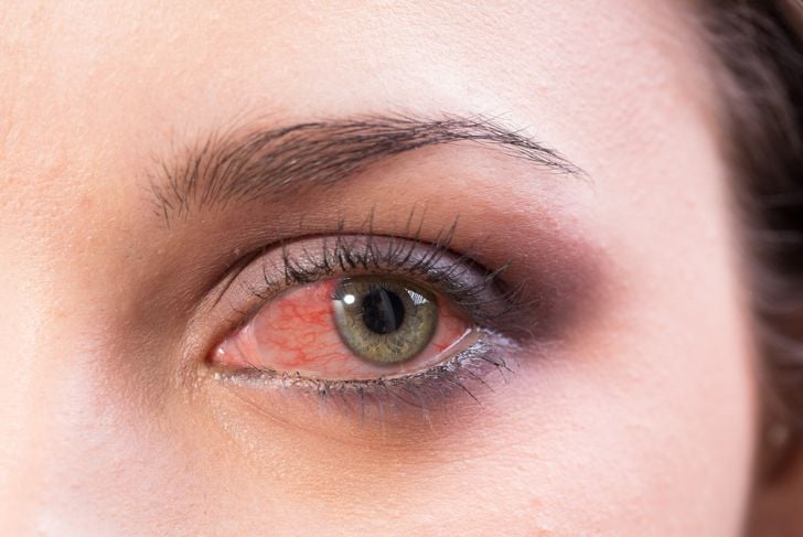 13 cause di occhi rossi 17