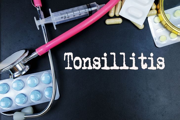 Cosa sono i calcoli tonsillari? 5