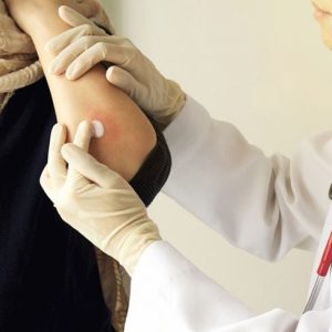 Sintomi e trattamenti della sporotricosi Sintomi e trattamenti della sporotricosi