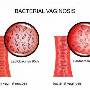 10 Sintomi e trattamenti della vaginosi batterica 10 Sintomi e trattamenti della vaginosi batterica