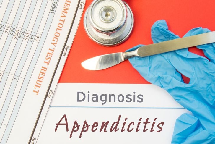 Sintomi, cause e prognosi dell'appendicite epiploica 17