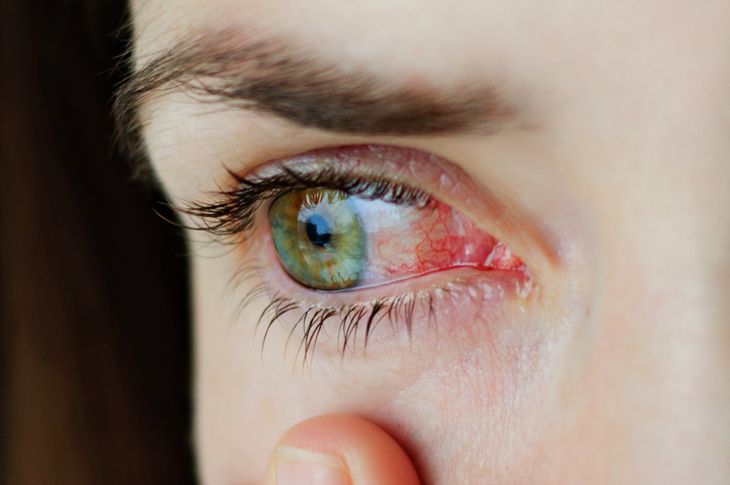 13 cause di occhi rossi 15