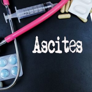 10 fatti sull’ascite che dovreste conoscere 10 fatti sull’ascite che dovreste conoscere
