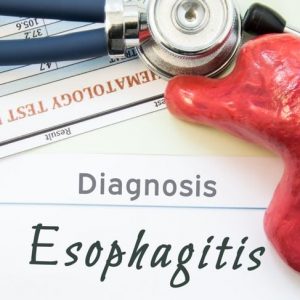 Che cos’è l’esofagite? Sintomi e trattamento