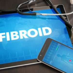 Tutto quello che le donne devono sapere sui fibromi Tutto quello che le donne devono sapere sui fibromi