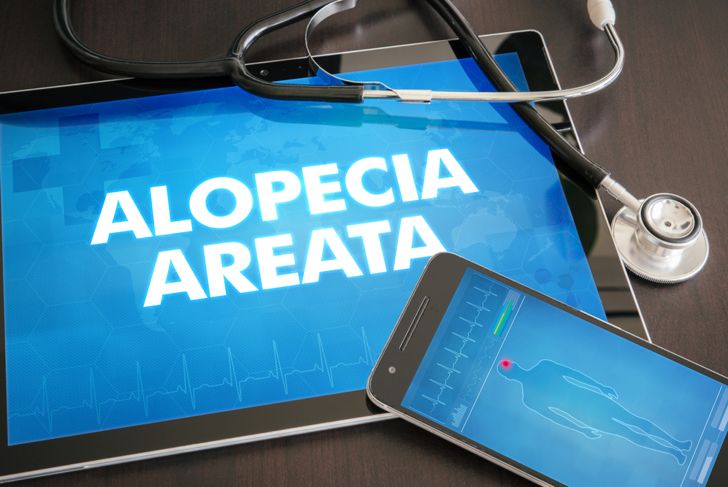 Che cos'è l'alopecia areata? 11