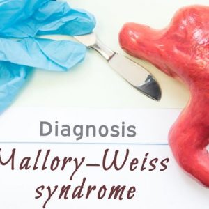 Sintomi e cause della sindrome di Mallory-Weiss
