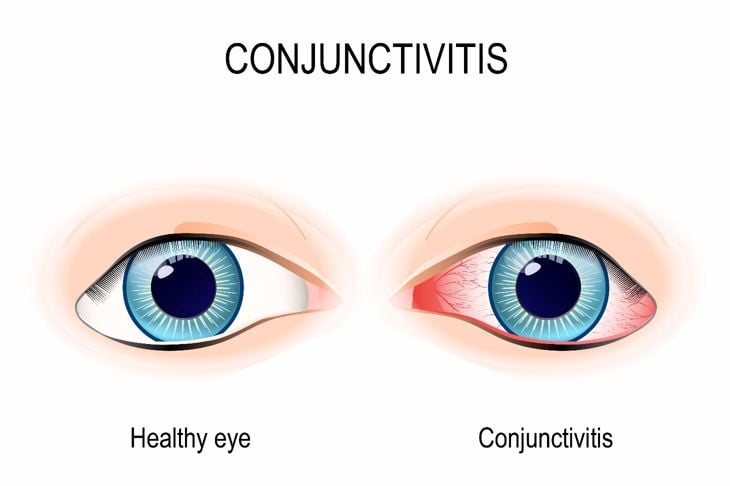 Cosa causa gli occhi rossi? 1