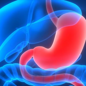 Cosa sono i tumori stromali gastrointestinali (GIST)?