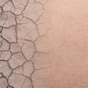 Pelle secca e squamosa? Scopri l’ittiosi Pelle secca e squamosa? Scopri l’ittiosi