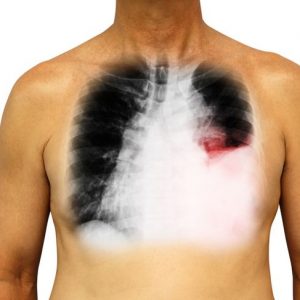 10 Cause, sintomi e trattamenti del versamento pleurico 10 Cause, sintomi e trattamenti del versamento pleurico