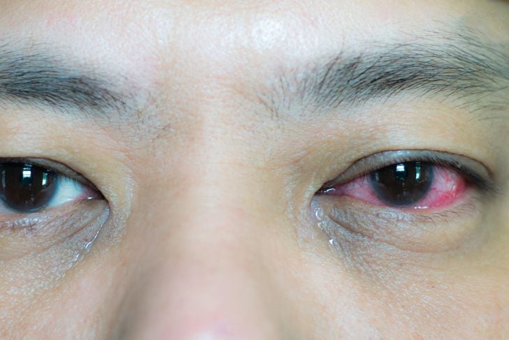13 cause di occhi rossi 23