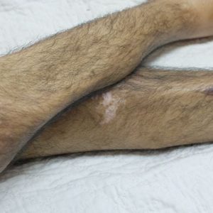 Domande frequenti sulla malattia da deperimento cronico Domande frequenti sulla malattia da deperimento cronico