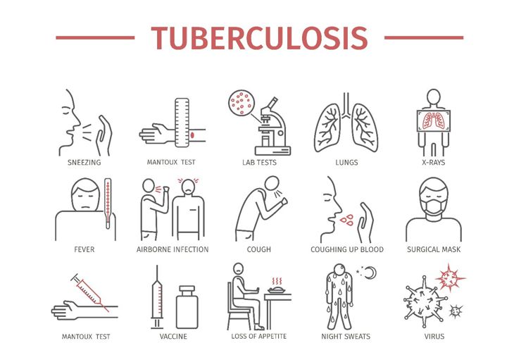 Che cos'è la tubercolosi polmonare? 5